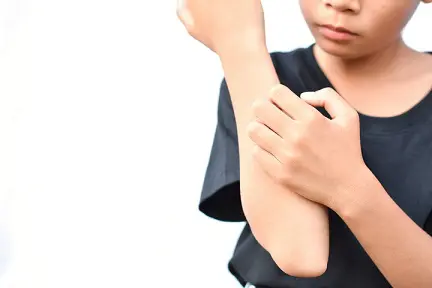 Atopic Dermatitis in Children