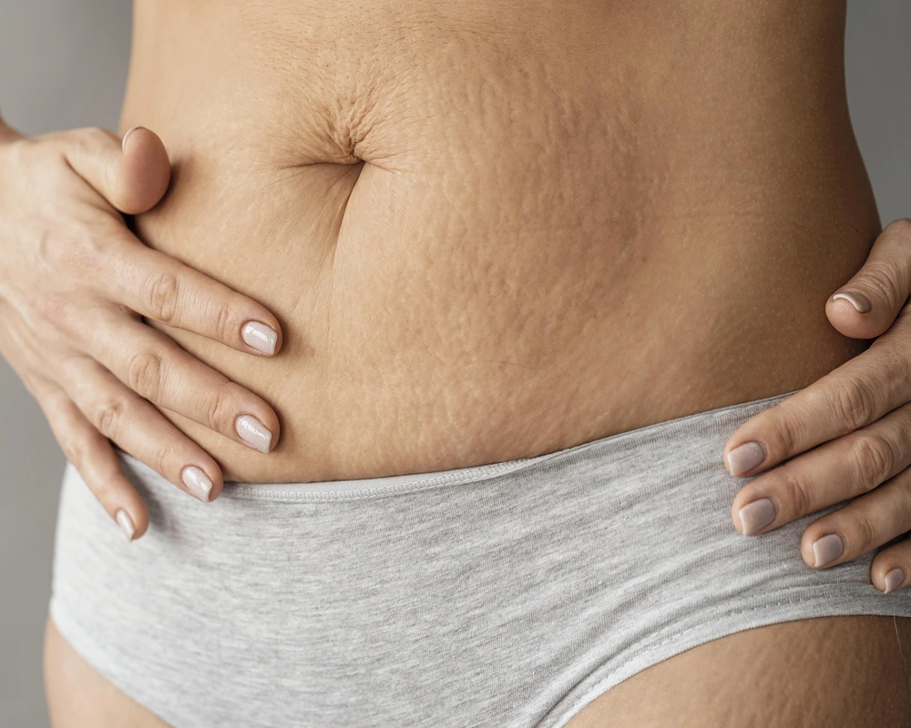 5 Effective Ways to Prevent Stretch Marks