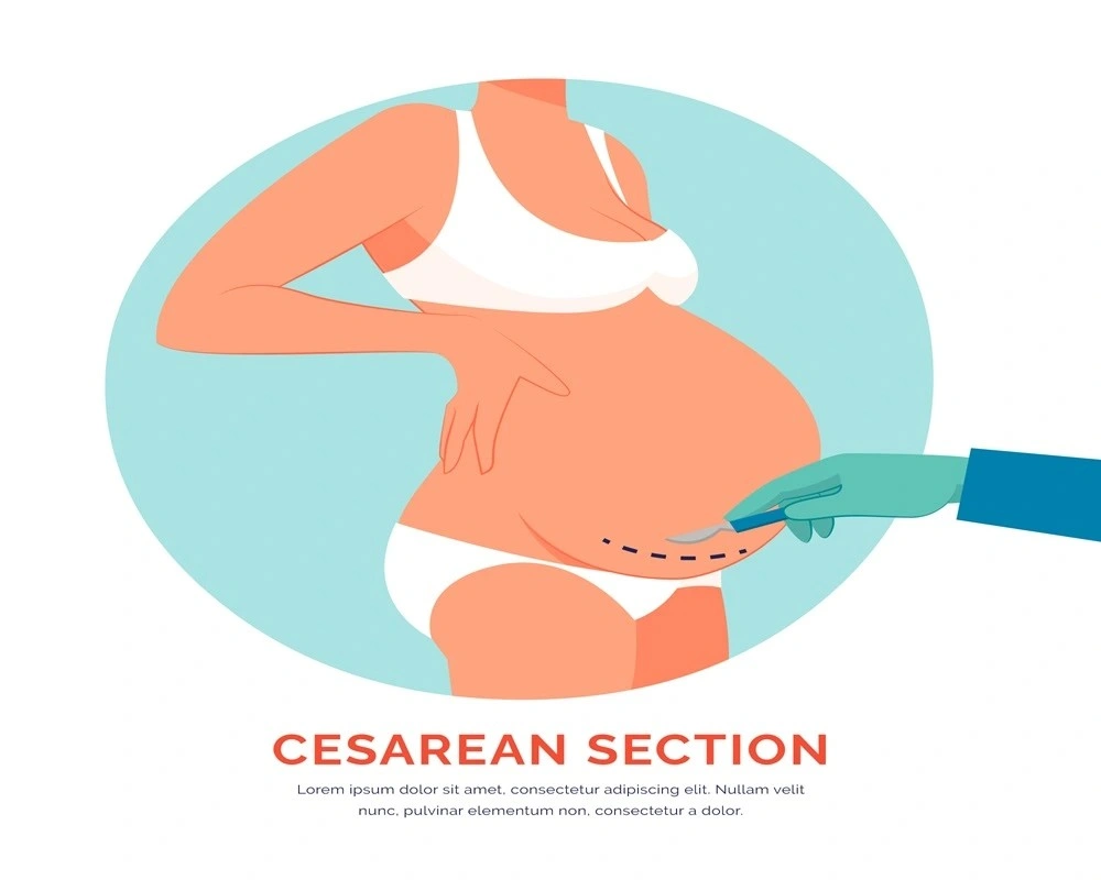 Lower section Caesarean Delivery