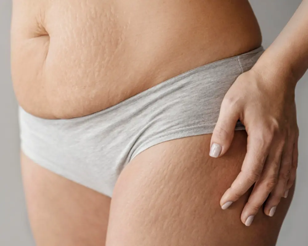Debunking Common Myths About Pregnancy Stretch Marks