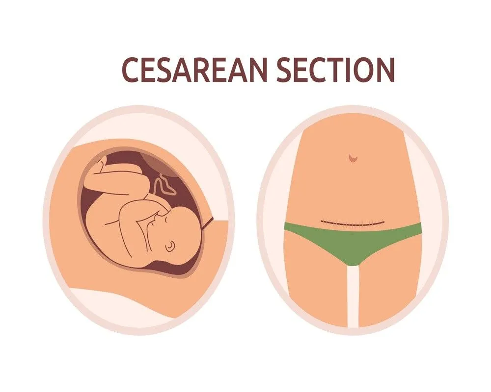 Understanding C-Section Recovery: Timeline, Risks, and What to Expect