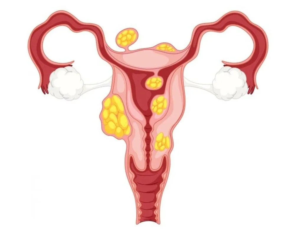 Ovarian Dermoid Cyst Explained: Symptoms, Causes & Treatment